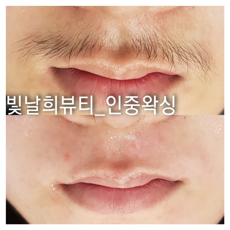  수염이 나기 시작한 중고등학생 면도하지말고 왁싱으로 뽑으세요!