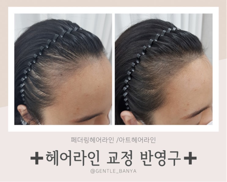  두피문신과 헤어증모술로 탈모 고민 해결!!