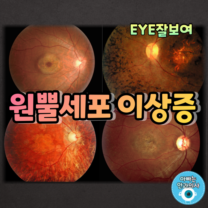  [EYE잘보여] 원뿔세포이상증, 원추세포이상증(Cone Dystrophy) - 태양을 피하고 싶었어