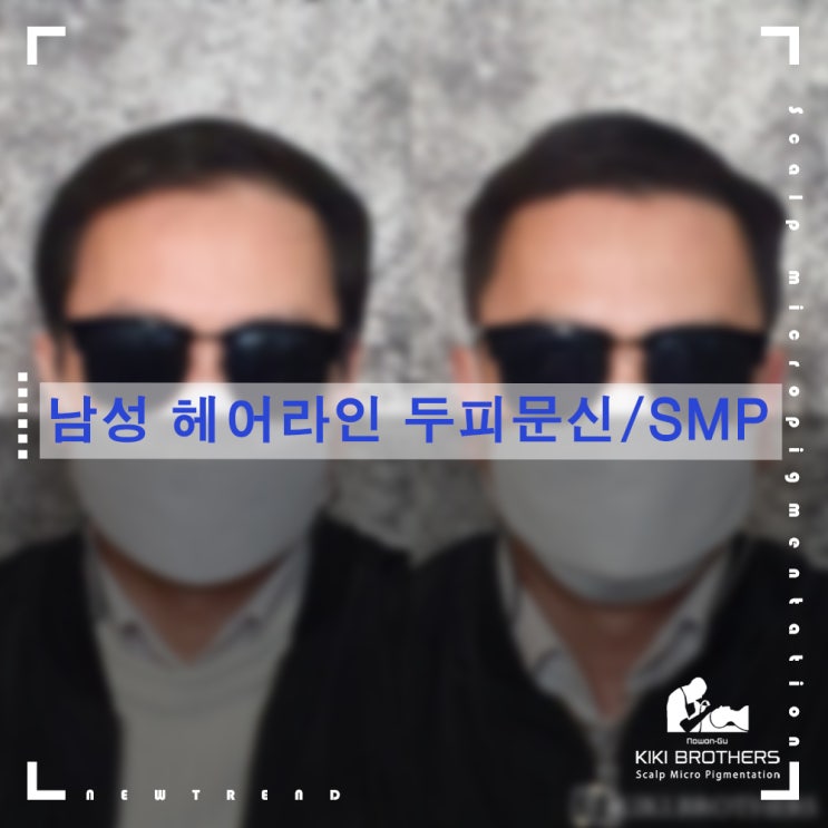 남자 헤어라인 + 정수리 탈모커버, 수유 두피문신/SMP 키키브라더스 노원
