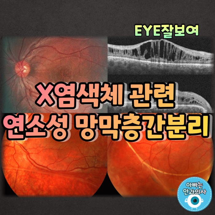  [EYE잘보여] X염색체관련연소망막층간분리(X-Linked Juvenile Retinoschisis)