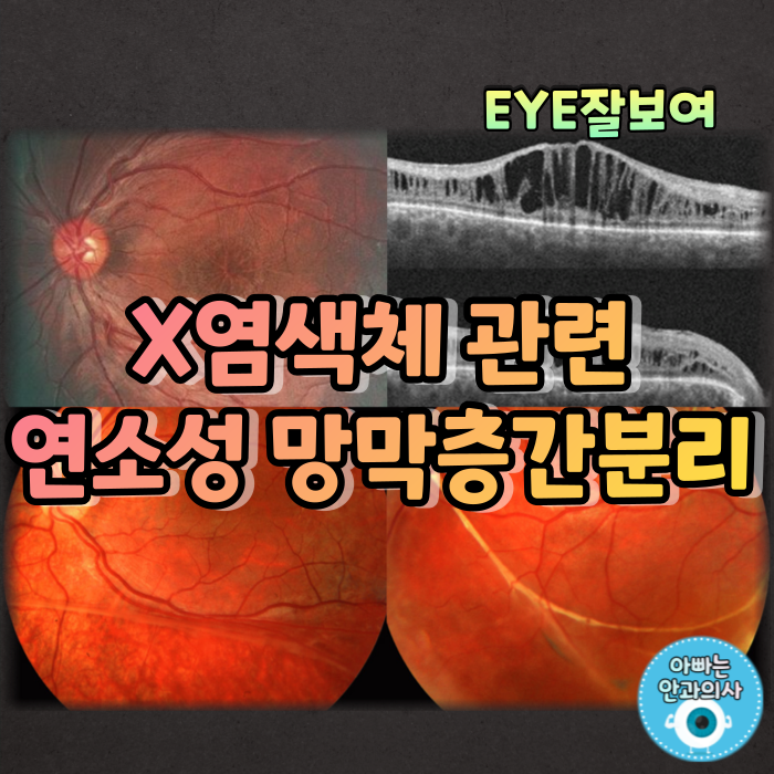 [EYE잘보여] X염색체관련연소망막층간분리(X-Linked Juvenile Retinoschisis)