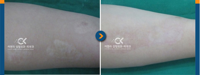  담배빵 흉터, 넓은 부위의 담배빵 치료는 초박편 피부이식술로