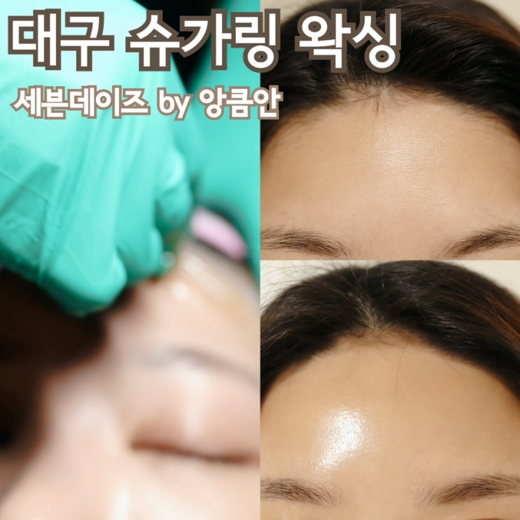  대구슈가링왁싱 세븐데이즈 by 앙큼안 에서 헤어라인 깔끔하게!