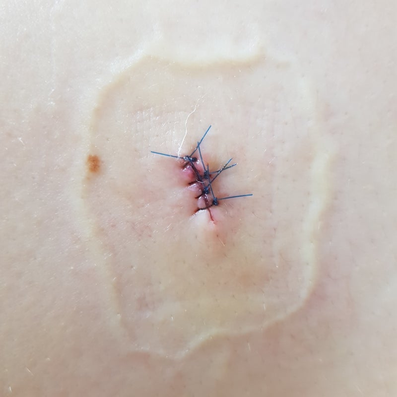 정확한 흑색종 생검을 수행하는 방법