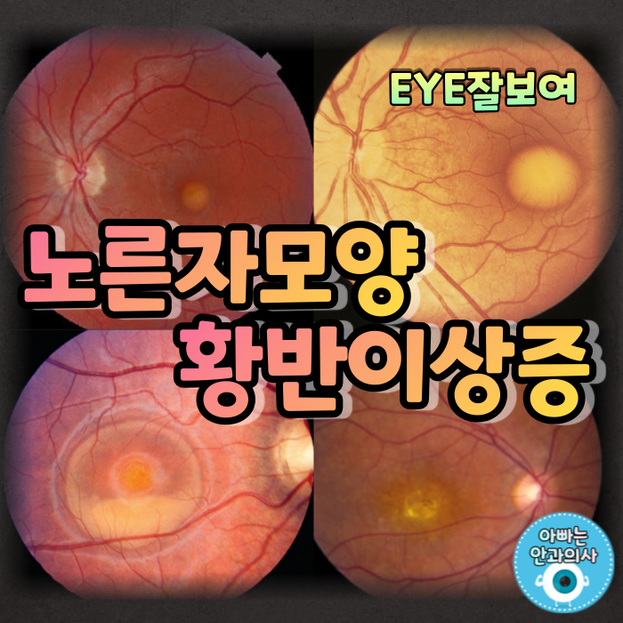 [EYE잘보여] 노른자모양황반이상증(Vitelliform Macular Dystrophy) - 눈 안에 달걀이?!