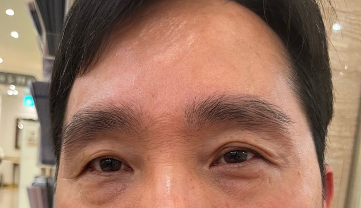  눈밑지방재배치레이저/ 눈밑지방제거레이저/눈밑필러 /눈밑 보톡스/중년 하안검 시술 일주일 후기/내돈내산