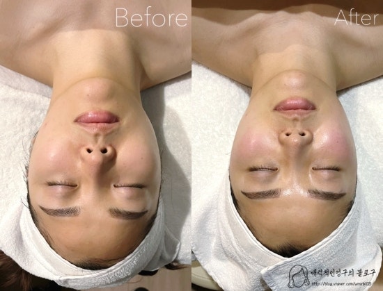  HNSPA 도곡 프리미엄 스파, 동안미소케어 하이푸 리프팅 후기 :)