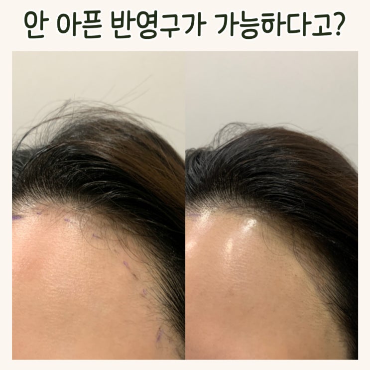  투엠 메이크업 강남무통헤어라인(NP기법) by. 통증 없어서 놀랐던 반영구 후기