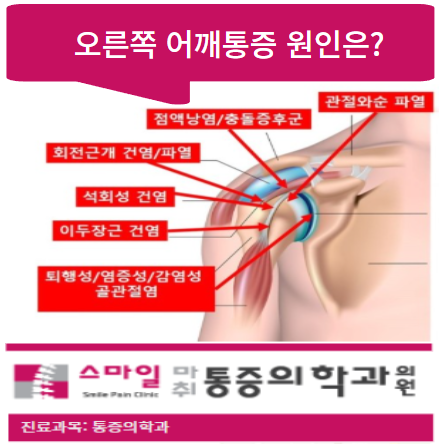  오른쪽어깨통증원인: 회전근개파열