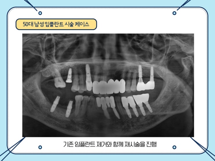 50대 남성 기존 임플란트 제거 및 추가 임플란트 군자플란트치과 방문 케이스