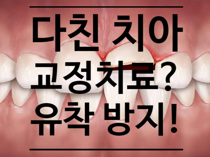 다친 치아는 언제부터 교정이 가능할까? 빠졌던 치아 교정에 관하여, 치아 유착 안되게 하는 방법