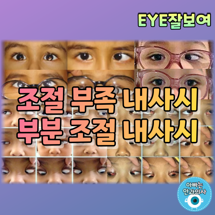  [EYE잘보여] 조절(Accommodative) 내사시 (2) - 조절부족 내사시, 부분조절 내사시