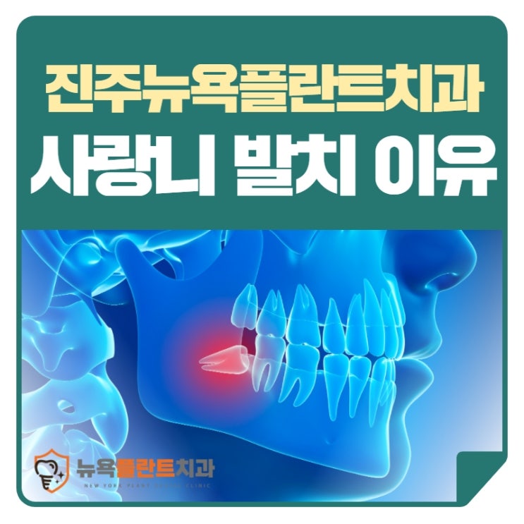  진주사랑니 발치 이유, 꼭 뽑아야 하나요?