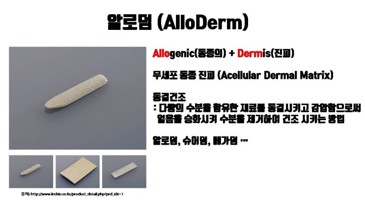  이전 코수술로 이식된 기증진피 (알로덤, 슈어덤, 메가덤) 코재수술로 제거 가능해요!!!
