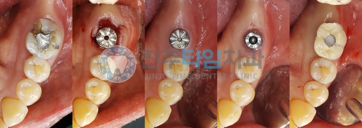  발치후 즉시식립 & 각화치은 증대술 #루이버튼 #큐레이 #진주타임치과