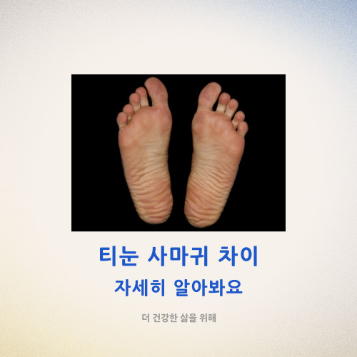  티눈 사마귀 차이 자세히 알아봐요