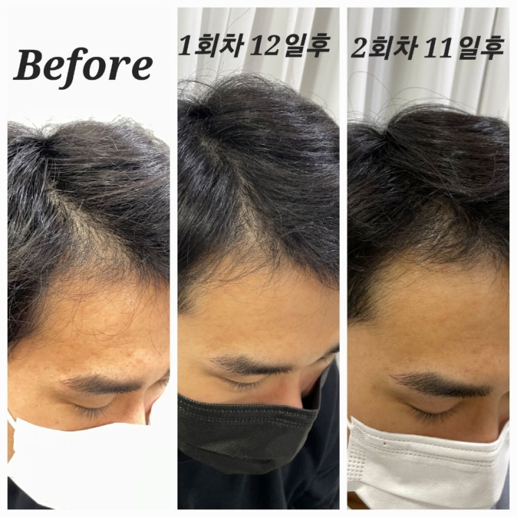  대구 탈모/두피 관리 :: 백신 부작용 탈모 증상 해결한 상인동 이유 뷰티 솔직 후기