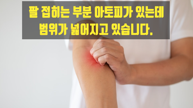  팔 접히는 부분 아토피가 있는데 범위가 넓어지고 있습니다