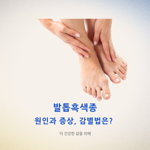  발톱흑색종의 원인과 증상, 감별법은?