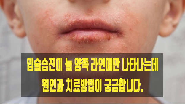 입술습진이 늘 양쪽 라인에만 나타나는데 원인과 치료방법이 궁금합니다.