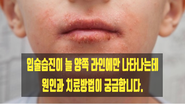  입술습진이 늘 양쪽 라인에만 나타나는데 원인과 치료방법이 궁금합니다.