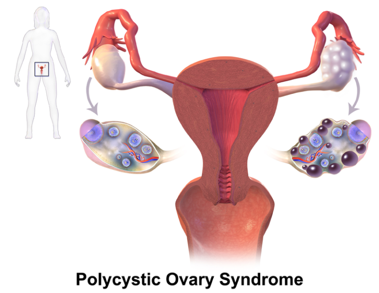  창원한의원 다낭성난소증후군(PCOS) 꿈틀한의원에서 치료하세요