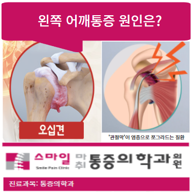  왼쪽어깨통증원인 : 오십견