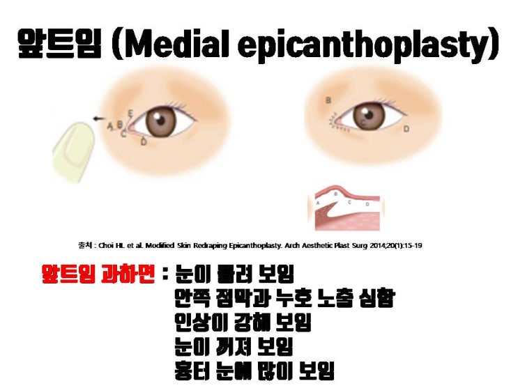  과도한 앞트임으로 징그러워 보이는 안쪽 눈구석 몽고주름 복원이 답이죠!!!