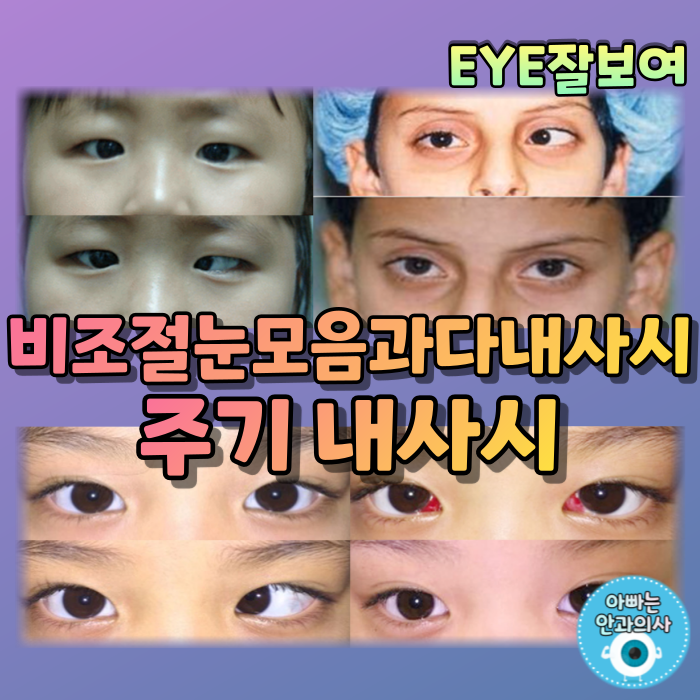  [EYE잘보여] 비조절 눈모음과다 내사시 & 주기 내사시