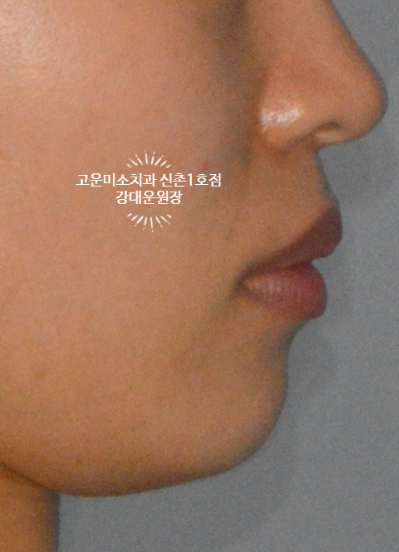  [돌출+발치교정] 입술이 뚱해 보여요