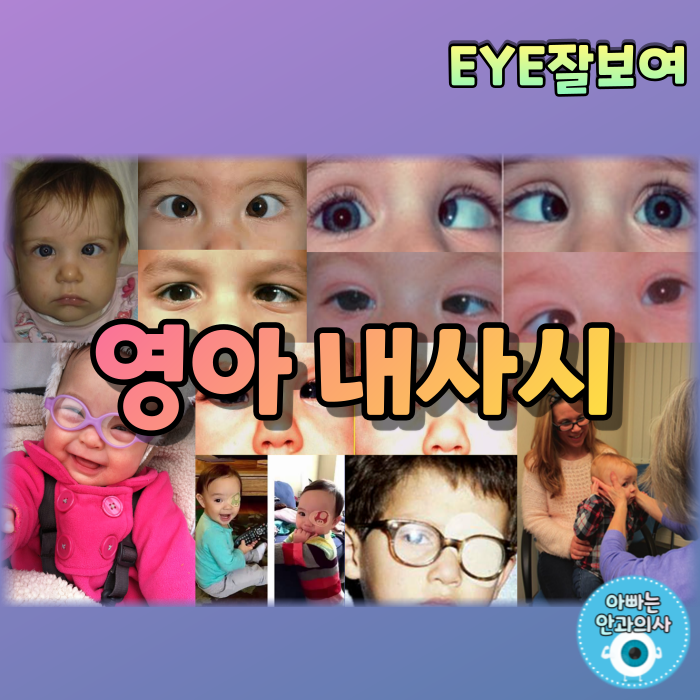  [EYE잘보여] 영아내사시(Infantile Esotropia), 소아내사시, 신생아내사시