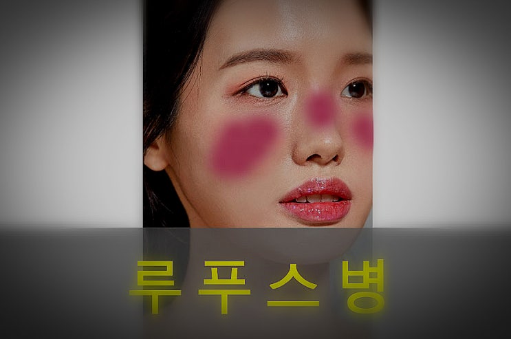  자가면역질환 루푸스병 다양한 원인과 증상, 예방, 좋은 음식