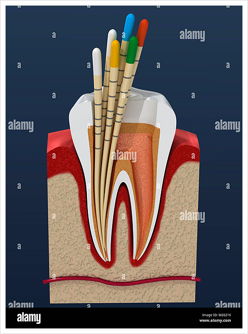 은평구치과!&lt; 통증이 있다면 치아에 '금' 이 간것인지 확인해 보세요~&gt;