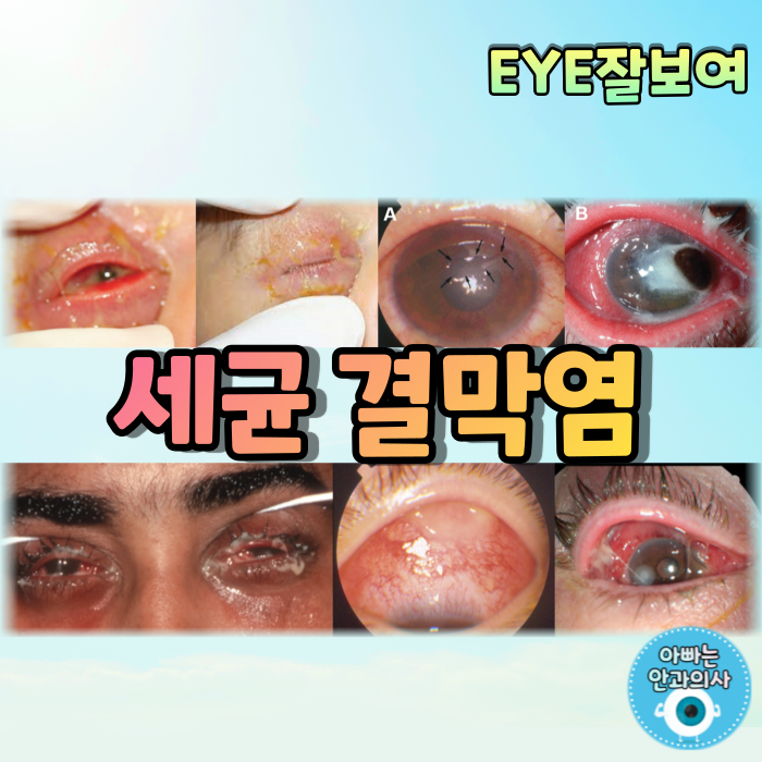 [EYE잘보여] 세균결막염(Bacterial Conjunctivitis)의 증상과 치료