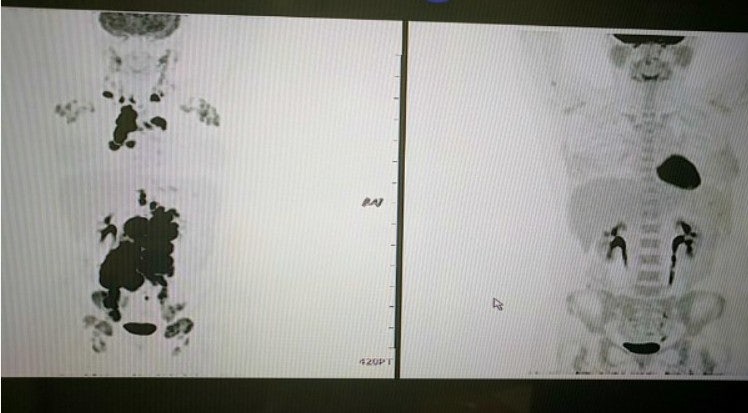 소포성 림프종 증상, 기수, 그레이드, 항암치료, 유지치료, 재발 및 예후