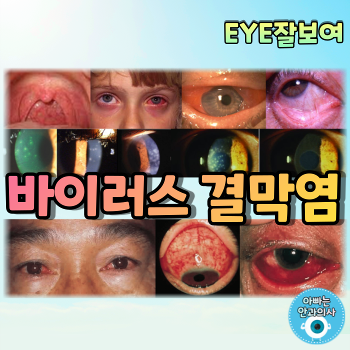 [EYE잘보여] 바이러스 결막염 - 유행성각결막염(EKC), 아폴로눈병