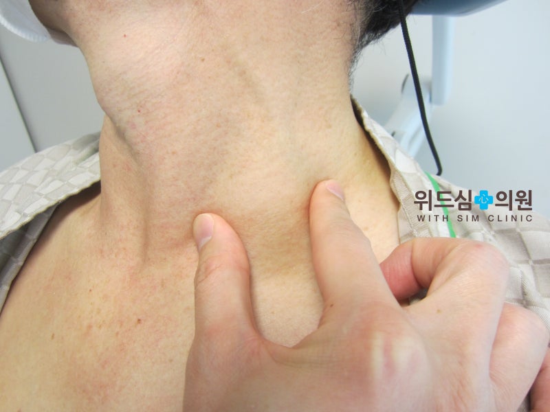 왼쪽 목의 응어리 갑상선 초음파 검사로 초기 대처가 가능합니다.