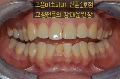  [부분교정] 아래 앞니가 틀어졌어요