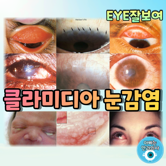[EYE잘보여] 클라미디아 눈감염 - 트라코마, 봉입체 결막염