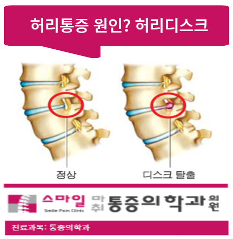  [일산허리디스크병원]잦은 허리통증의 원인? 허리디스크증세 및 원인