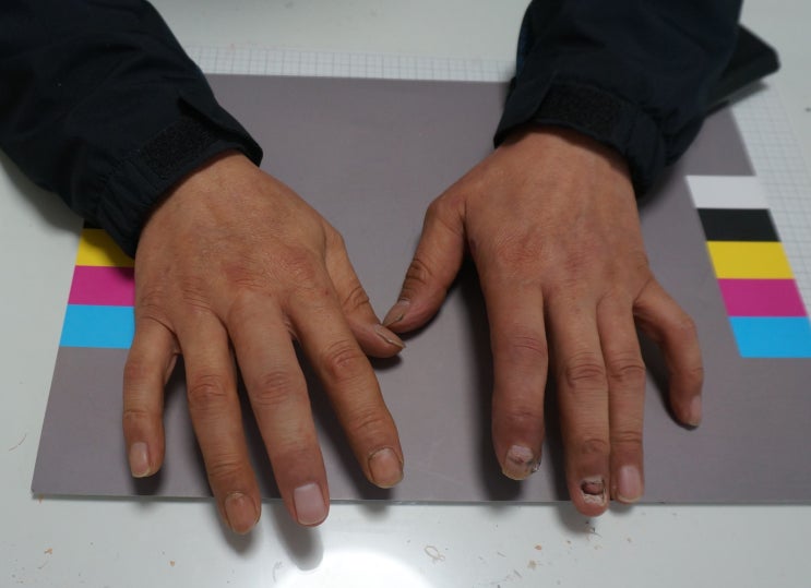  100% 맞춤 실리콘 손가락으로 자신감 회복!!
