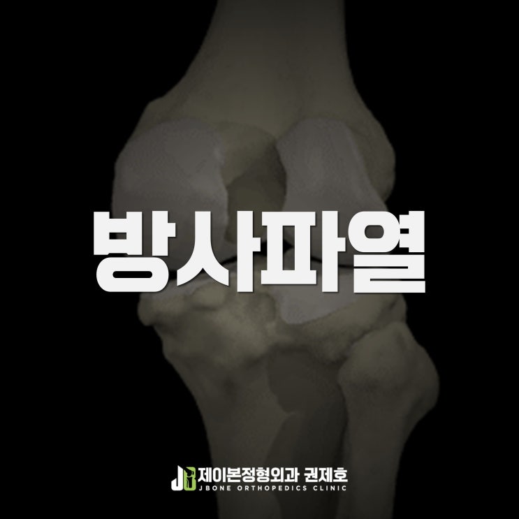 방사파열 radial 쪼개진 연골판 / 제이본 권제호