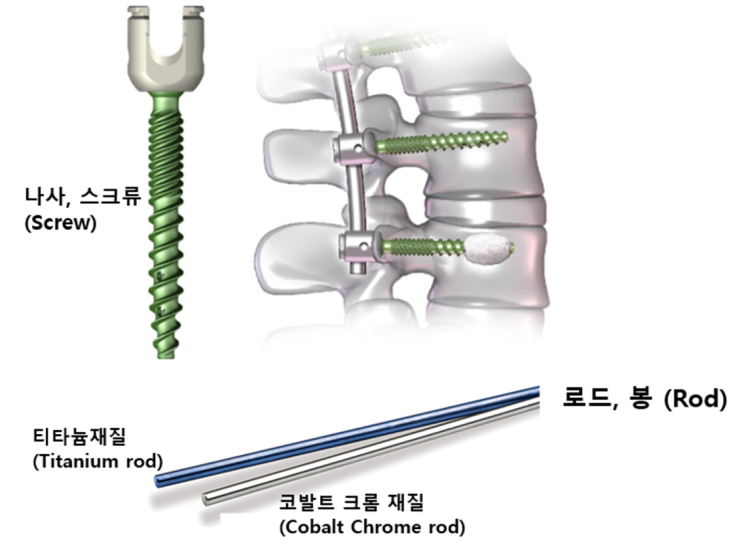  척추 나사못 박는 수술(유합술) 은 무엇인가요? 꼭 해야하나요? 나중에 빼야 하나요?