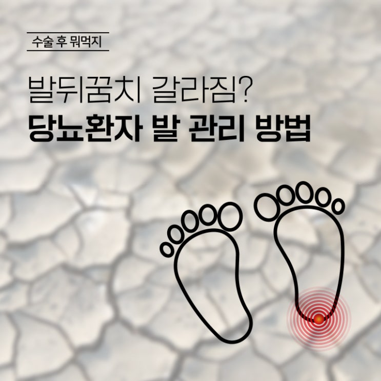  발뒤꿈치 갈라짐 해결, 당뇨환자라면 특히!