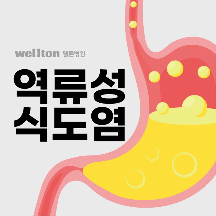  [마곡나루내과] 역류성식도염 속 쓰림과 함께 올라오는 신물, 이젠 속 좀 편해지고 싶어!
