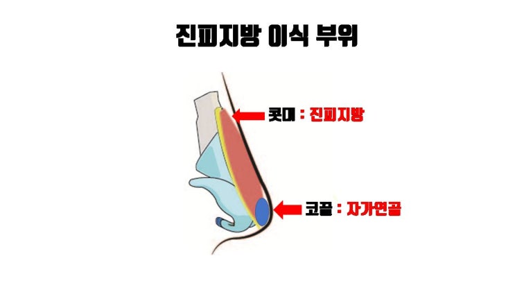  자가진피로 콧대를, 자가연골로 코끝을, 안전하면서도 예쁜 무보형물 코수술 가능해요!!!
