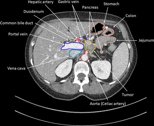 췌장암의 진단과 검사: CT (Diagnosis of Pancreatic Cancer:CT) : 네이버 블로그