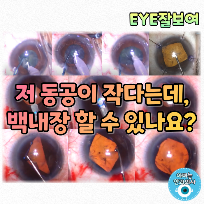  [EYE잘보여] 동공이 작은 환자의 백내장 수술은 어떻게?