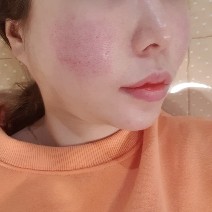  피부과전문의 여의사 피코프락셀레이저가격